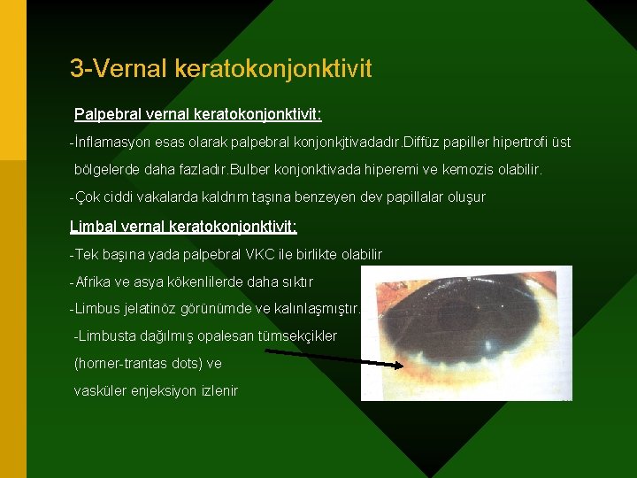 3 -Vernal keratokonjonktivit Palpebral vernal keratokonjonktivit: -İnflamasyon esas olarak palpebral konjonkjtivadadır. Diffüz papiller hipertrofi