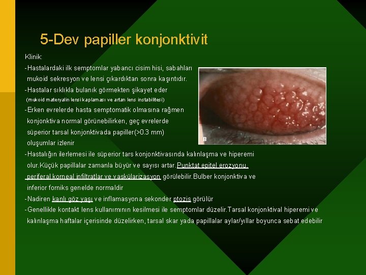 5 -Dev papiller konjonktivit Klinik: -Hastalardaki ilk semptomlar yabancı cisim hisi, sabahları mukoid sekresyon