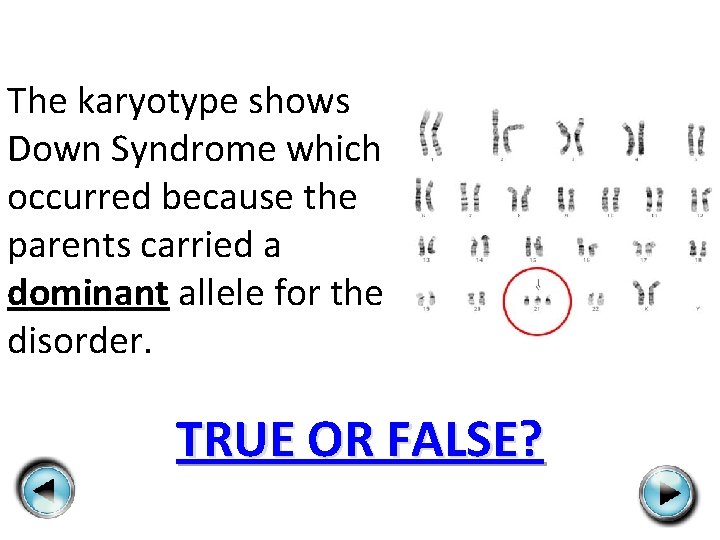 The karyotype shows Down Syndrome which occurred because the parents carried a dominant allele