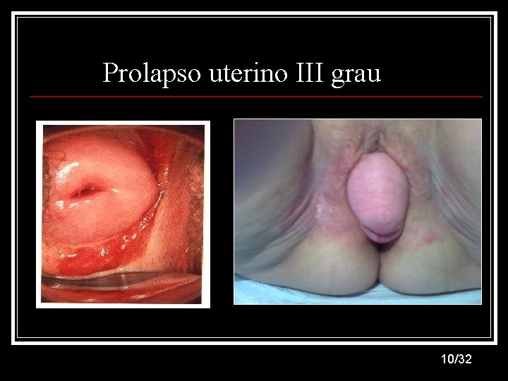 Prolapso uterino III grau 10/32 