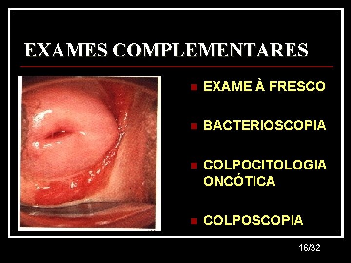 EXAMES COMPLEMENTARES n EXAME À FRESCO n BACTERIOSCOPIA n COLPOCITOLOGIA ONCÓTICA n COLPOSCOPIA 16/32