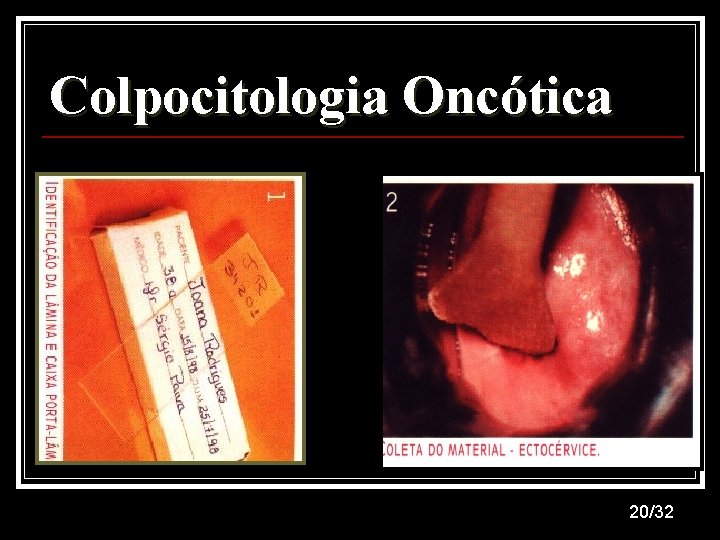 Colpocitologia Oncótica 20/32 