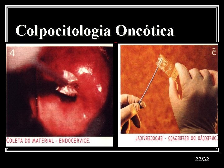 Colpocitologia Oncótica 22/32 