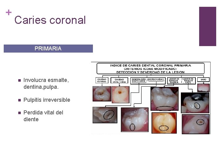 + Caries coronal PRIMARIA n Involucra esmalte, dentina, pulpa. n Pulpitis irreversible n Perdida