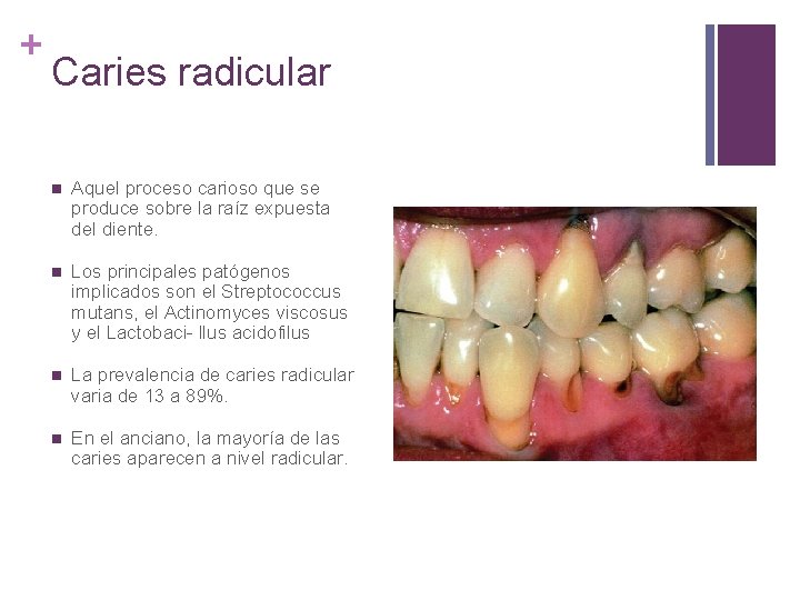 + Caries radicular n Aquel proceso carioso que se produce sobre la raíz expuesta