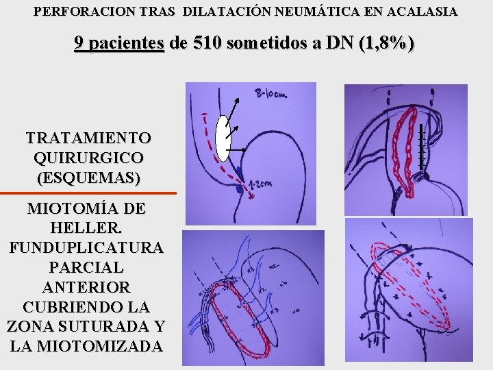 PERFORACION TRAS DILATACIÓN NEUMÁTICA EN ACALASIA 9 pacientes de 510 sometidos a DN (1,