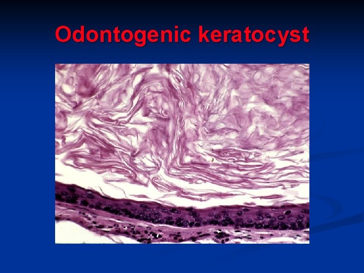 Odontogenic keratocyst 
