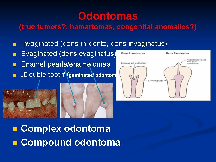 Odontomas (true tumors? , hamartomas, congenital anomalies? ) n n Invaginated (dens-in-dente, dens invaginatus)