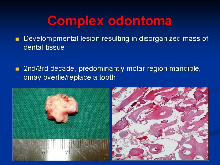 Complex odontoma n Develompmental lesion resulting in disorganized mass of dental tissue n 2