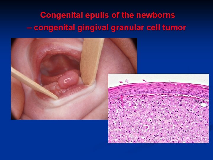 Congenital epulis of the newborns – congenital gingival granular cell tumor 