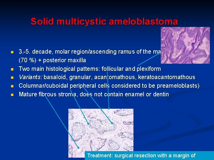 Solid multicystic ameloblastoma n n n 3. -5. decade, molar region/ascending ramus of the