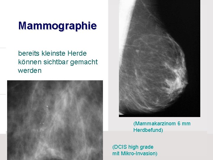 Mammographie bereits kleinste Herde können sichtbar gemacht werden (Mammakarzinom 6 mm Herdbefund) (DCIS high