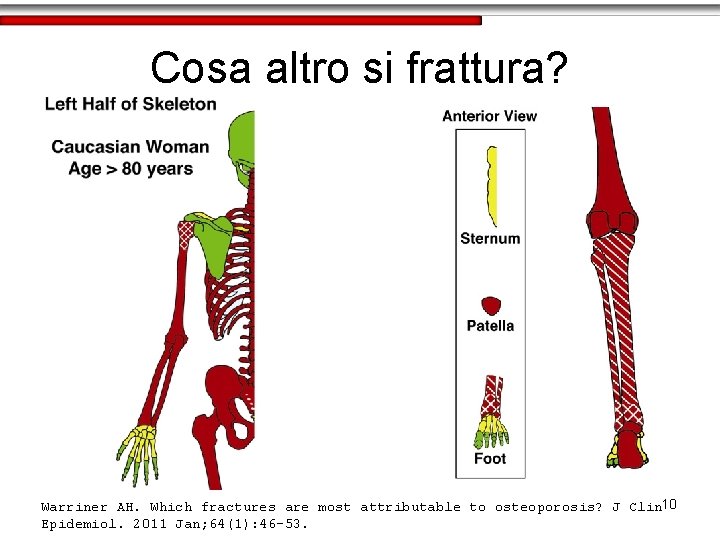Cosa altro si frattura? Warriner AH. Which fractures are most attributable to osteoporosis? J