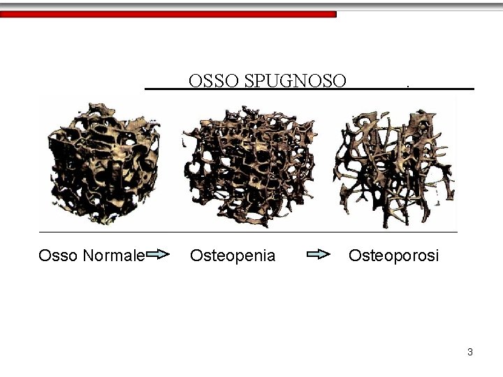 OSSO SPUGNOSO Osso Normale Osteopenia . Osteoporosi 3 