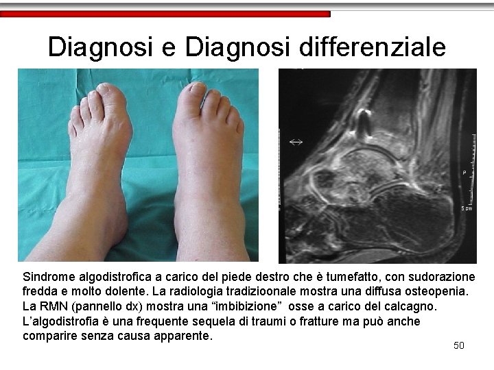 Diagnosi e Diagnosi differenziale Sindrome algodistrofica a carico del piede destro che è tumefatto,