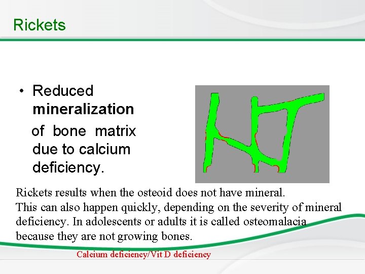 Rickets • Reduced mineralization of bone matrix due to calcium deficiency. Rickets results when