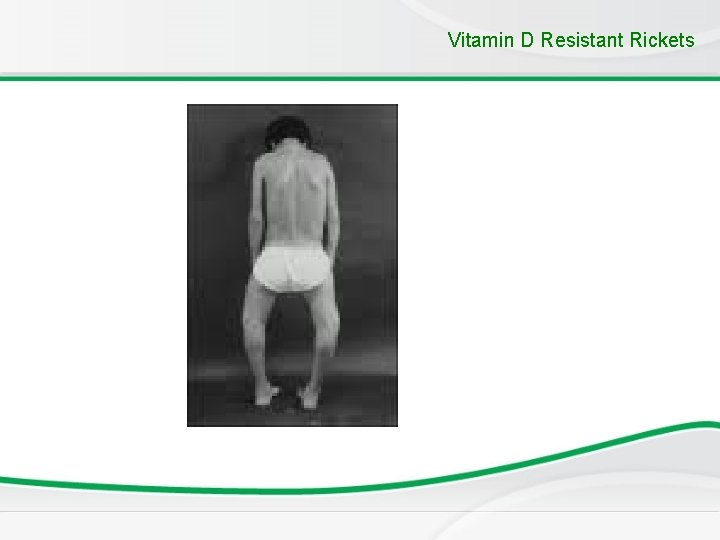 Vitamin D Resistant Rickets 