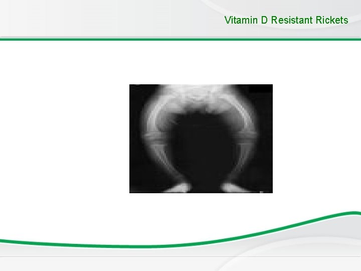 Vitamin D Resistant Rickets 