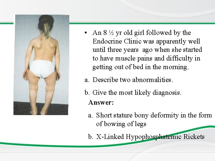  • An 8 ½ yr old girl followed by the Endocrine Clinic was