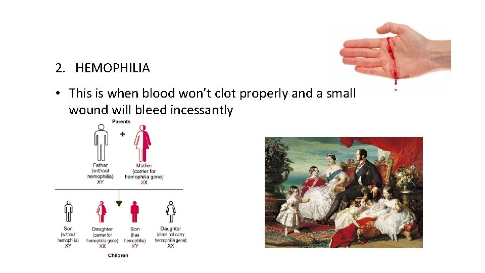 2. HEMOPHILIA • This is when blood won’t clot properly and a small wound