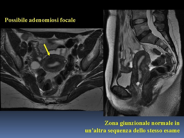 Possibile adenomiosi focale Zona giunzionale normale in un’altra sequenza dello stesso esame 