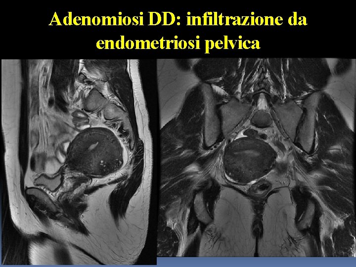 Adenomiosi DD: infiltrazione da endometriosi pelvica 