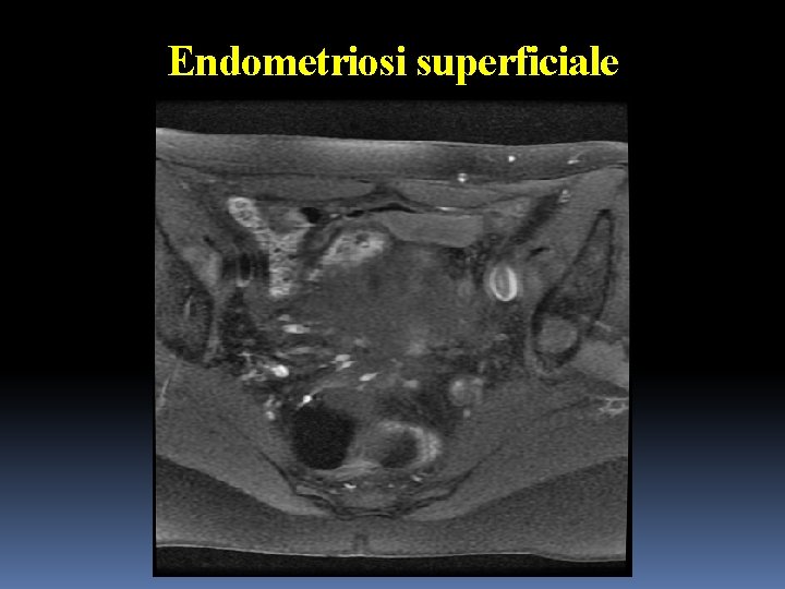 Endometriosi superficiale 