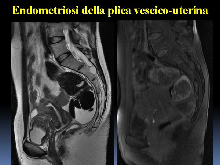 Endometriosi della plica vescico-uterina 