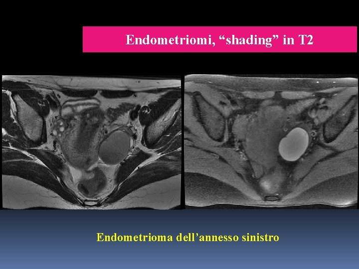 Endometriomi, “shading” in T 2 Endometrioma dell’annesso sinistro 