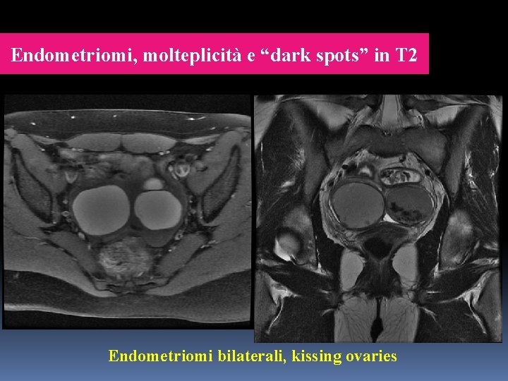 Endometriomi, molteplicità e “dark spots” in T 2 Endometriomi bilaterali, kissing ovaries 