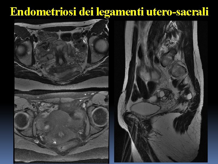 Endometriosi dei legamenti utero-sacrali 