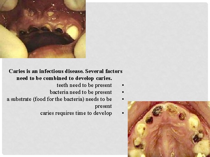 Caries is an infectious disease. Several factors need to be combined to develop caries.