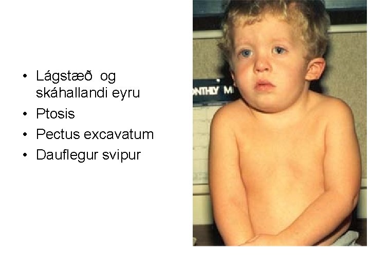  • Lágstæð og skáhallandi eyru • Ptosis • Pectus excavatum • Dauflegur svipur