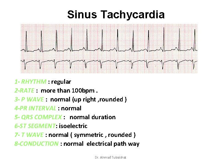 Sinus Tachycardia 1 - RHYTHM : regular 2 -RATE : more than 100 bpm.