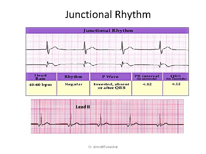 Junctional Rhythm Lead II Dr. Ahmad 11 Tubaishat 