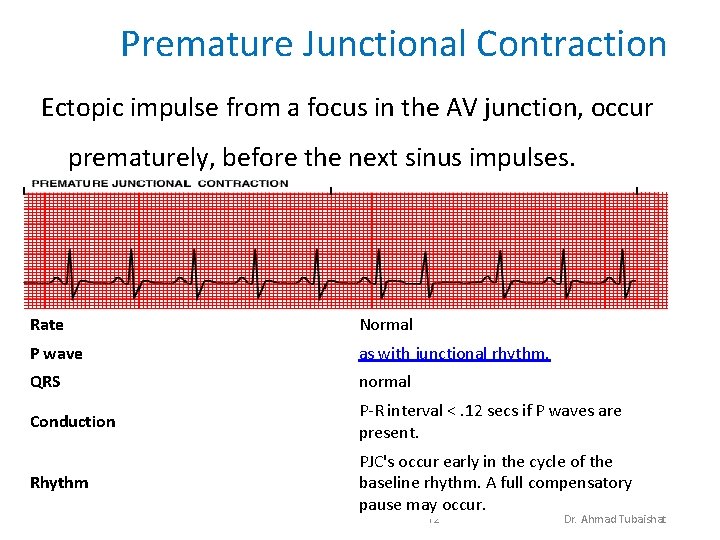 Premature Junctional Contraction Ectopic impulse from a focus in the AV junction, occur prematurely,