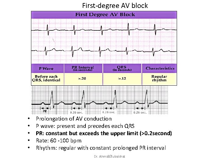 First-degree AV block • • • Prolongation of AV conduction P wave: present and