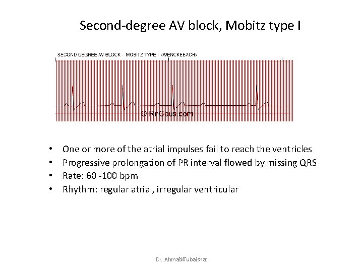 Second-degree AV block, Mobitz type I • • One or more of the atrial