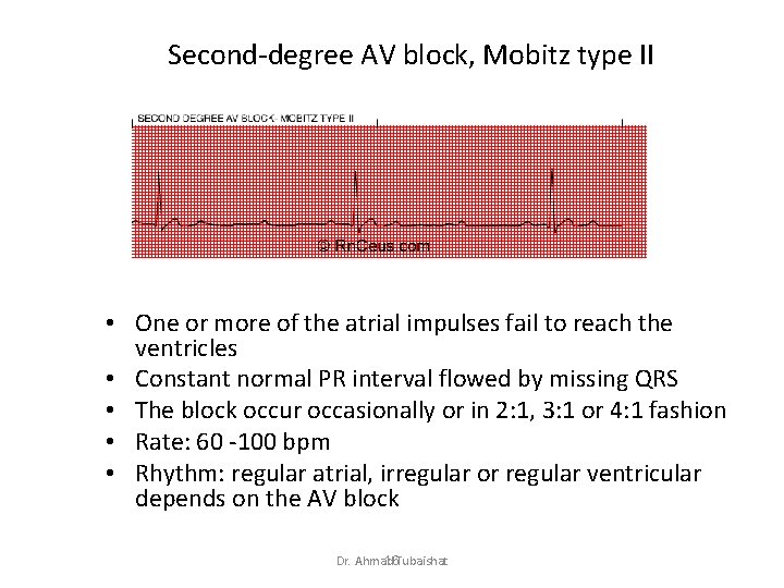 Second-degree AV block, Mobitz type II • One or more of the atrial impulses