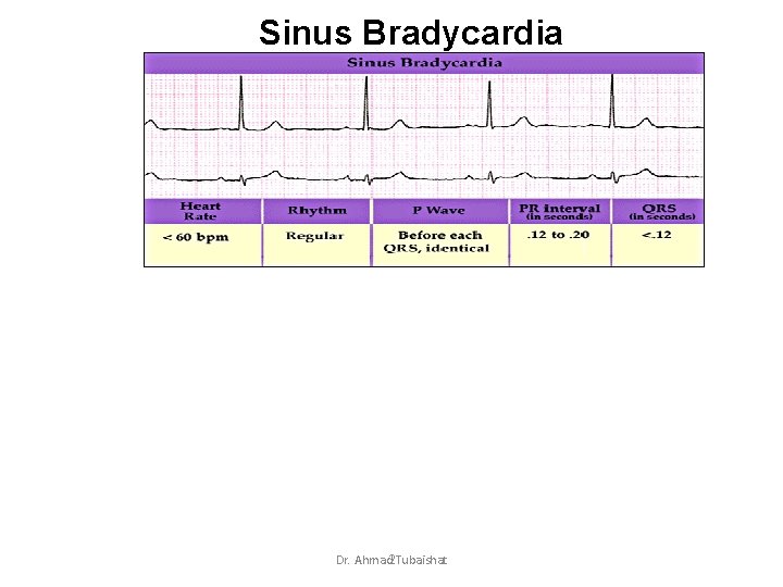 Sinus Bradycardia Dr. Ahmad 2 Tubaishat 
