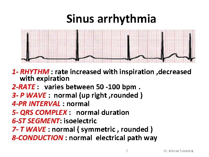 Sinus arrhythmia 1 - RHYTHM : rate increased with inspiration , decreased with expiration