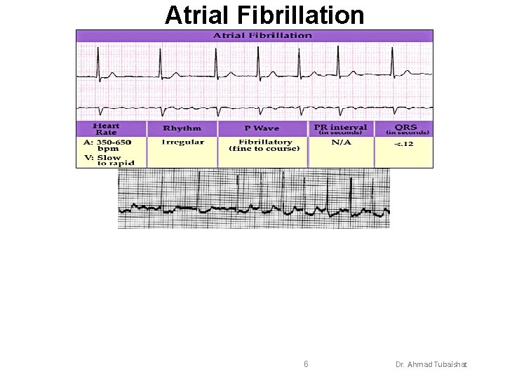 Atrial Fibrillation 6 Dr. Ahmad Tubaishat 