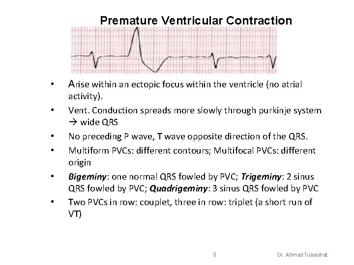 Premature Ventricular Contraction • • • Arise within an ectopic focus within the ventricle
