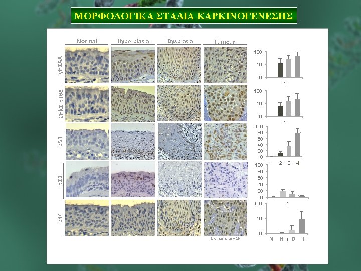 ΜΟΡΦΟΛΟΓΙΚΑ ΣΤΑΔΙΑ ΚΑΡΚΙΝΟΓΕΝΕΣΗΣ Normal Hyperplasia Dysplasia Tumour γH 2 AX 100 50 0 1