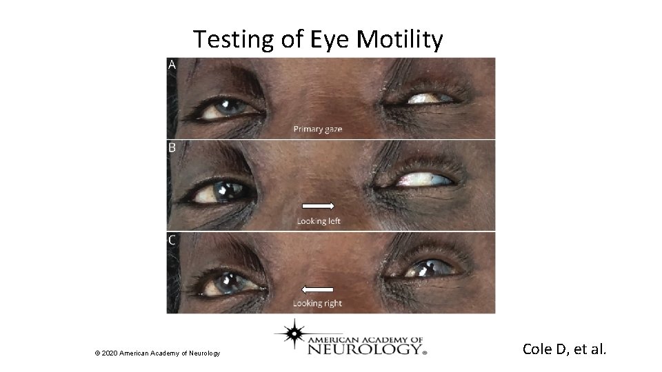 Testing of Eye Motility © 2020 American Academy of Neurology Cole D, et al.