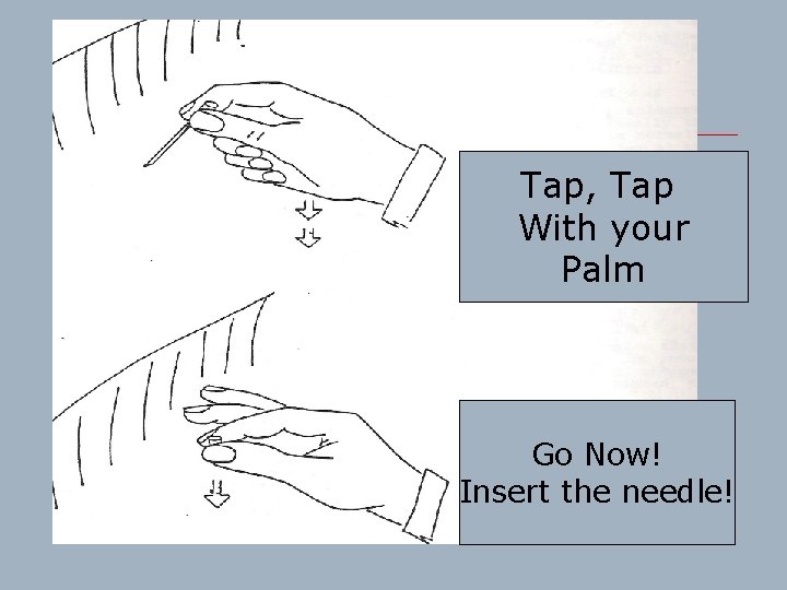 Tap, Tap With your Palm Go Now! Insert the needle! 