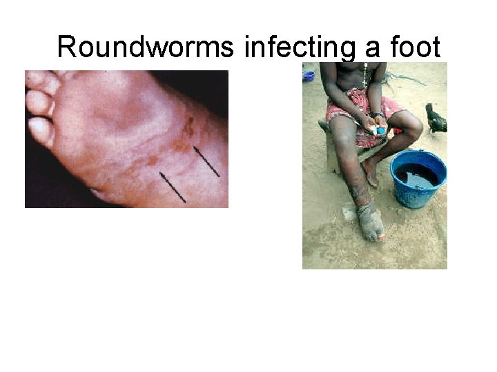 Roundworms infecting a foot 