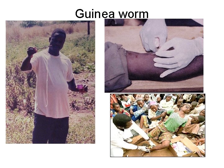 Guinea worm 