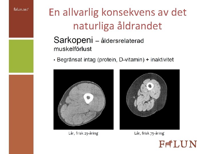 En allvarlig konsekvens av det naturliga åldrandet 