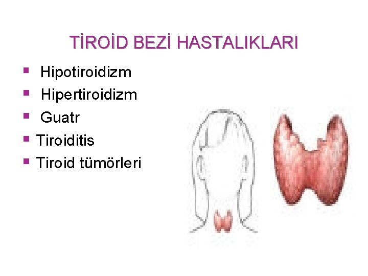 TİROİD BEZİ HASTALIKLARI § Hipotiroidizm § Hipertiroidizm § Guatr § Tiroiditis § Tiroid tümörleri